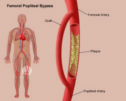 Những dấu hiệu và triệu chứng của xơ vữa động mạch là gi?