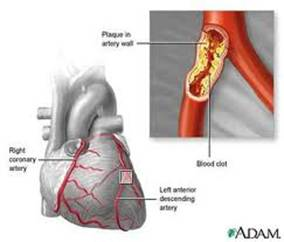 Bệnh xơ vữa động mạch là gì?